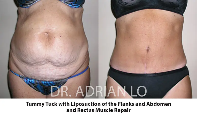 image of tummy tuck operation step-by-step results with muscle repair and liposuction