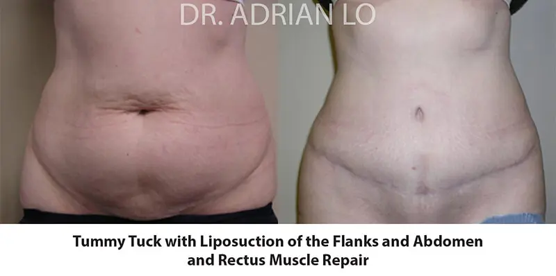 image of tummy tuck results with liposuction of the flanks and rectus muscle repair