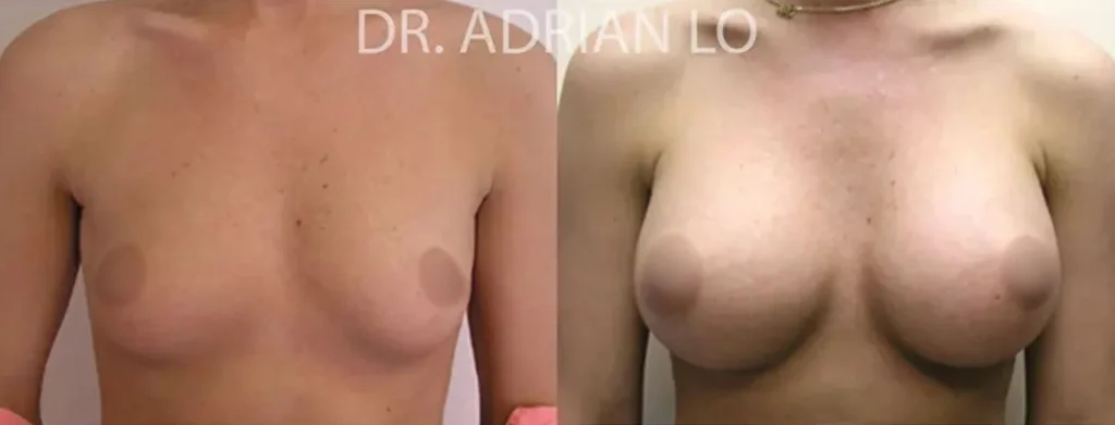 image of breast augmentation results showing which incision is best for breast augmentation