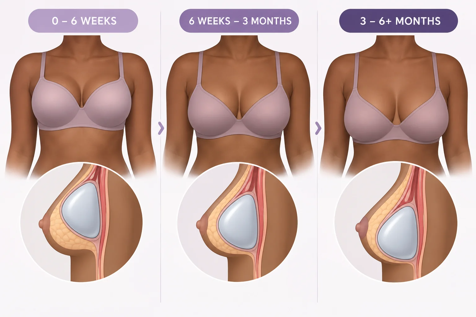 Diagram showing breast implants sitting too high in the first 6 weeks vs after 2-6 months post op