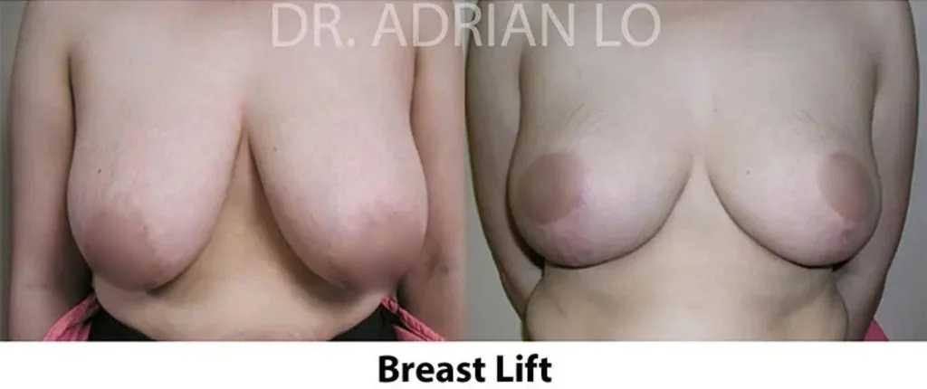 Before and after breast lift results by Dr. Adrian Lo showing lifted, repositioned breasts