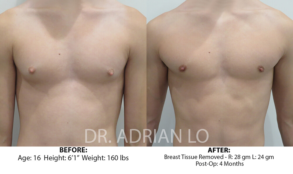 For Men Before and After Patient 1
