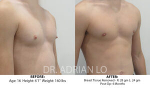 For Men Before and After Patient Thumbnail 2