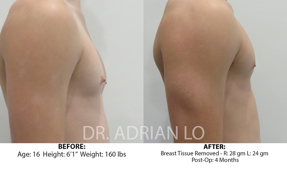 For Men Before and After Patient 3