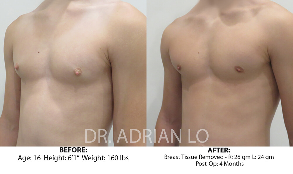 For Men Before and After Patient 4