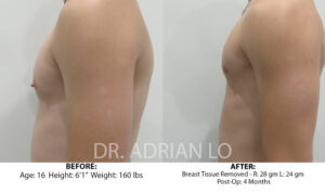 For Men Before and After Patient Thumbnail 5