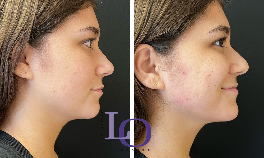 Dermal Fillers - Face Before and After Patient 1