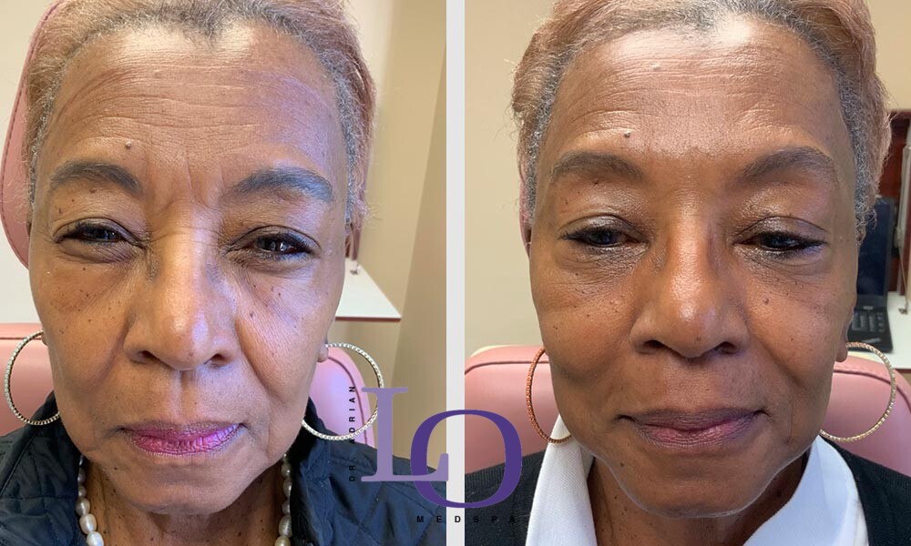 Botox® Cosmetic Before and After Patient 1