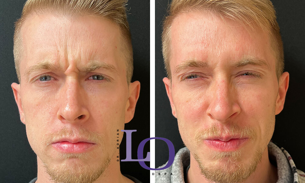 Botox® Cosmetic Before and After Patient 2