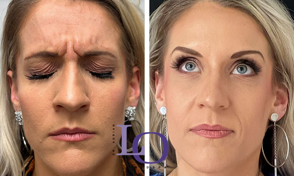 Botox® Cosmetic Before and After Patient 2