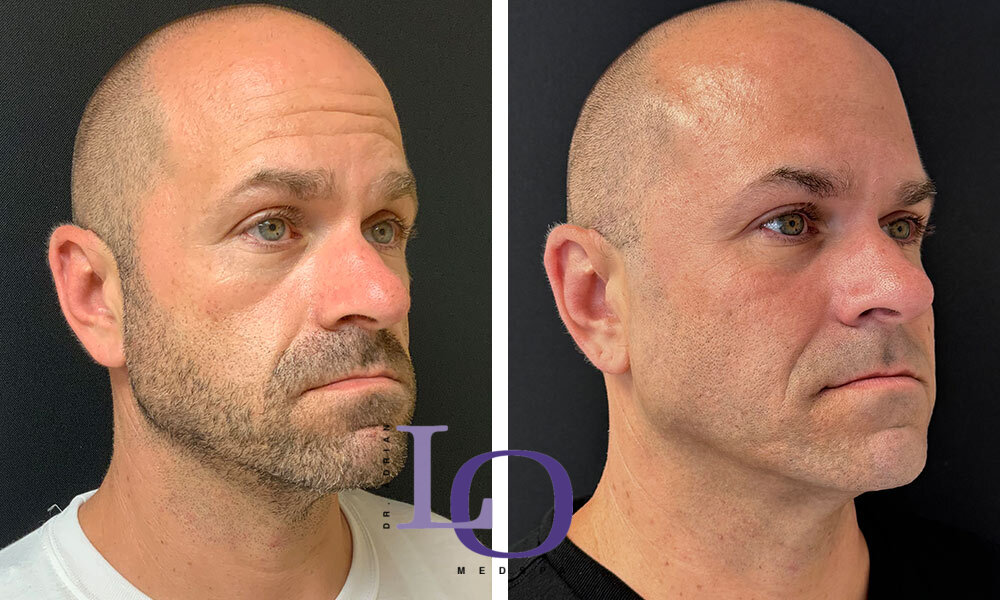 Botox® Cosmetic Before and After Patient 2
