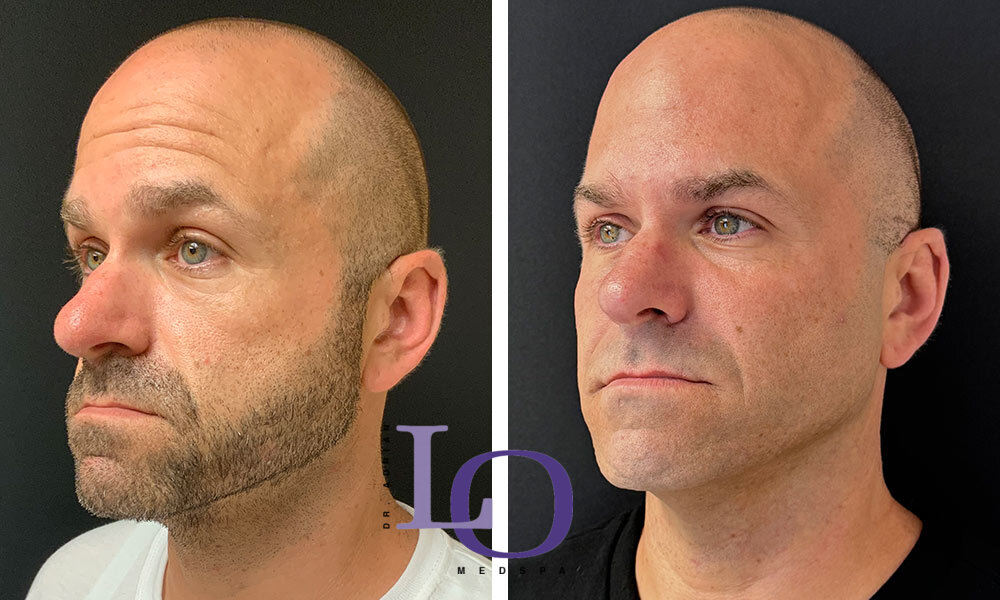 Botox® Cosmetic Before and After Patient 3