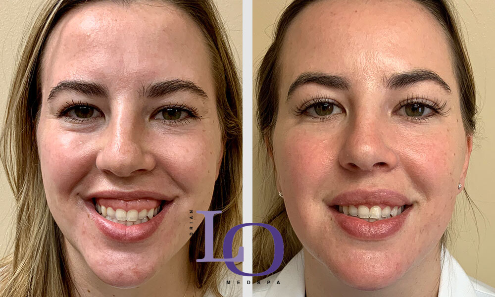 Botox® Cosmetic Before and After Patient 1