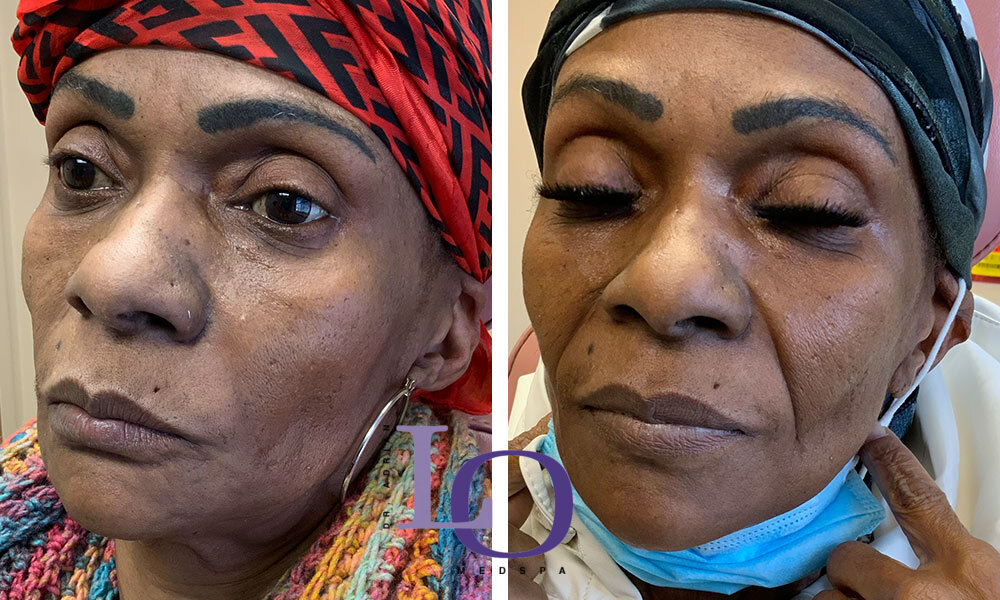 Dermal Fillers - Face Before and After Patient 2