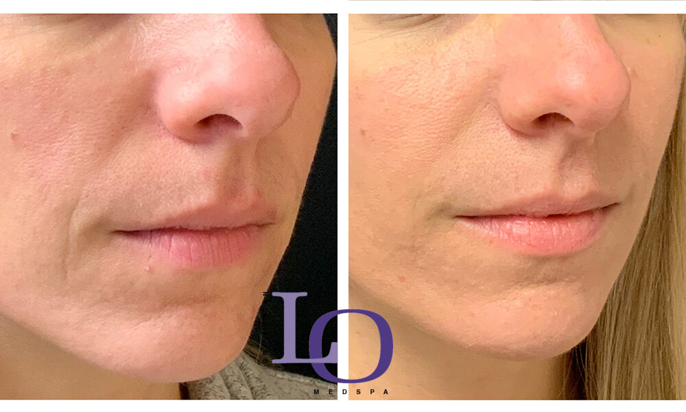 Dermal Fillers - Face Before and After Patient 2