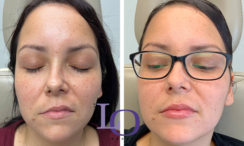 Dermal Fillers - Lips Before and After Patient 1