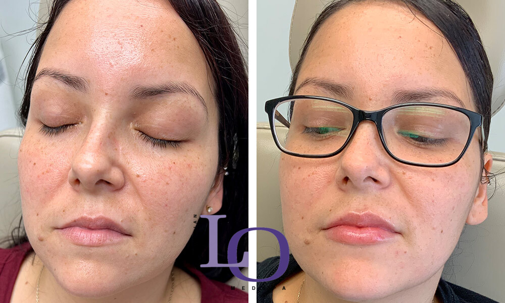 Dermal Fillers - Lips Before and After Patient 2