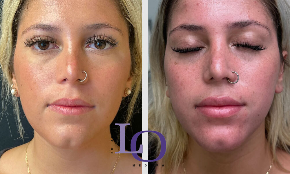 Dermal Fillers - Lips Before and After Patient 1
