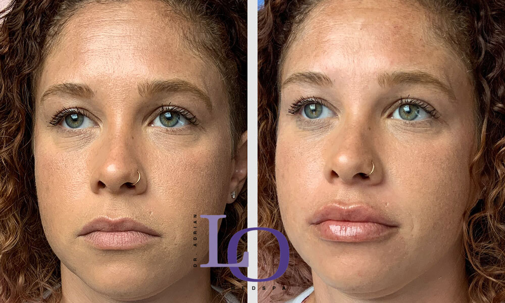 Dermal Fillers - Lips Before and After Patient 1