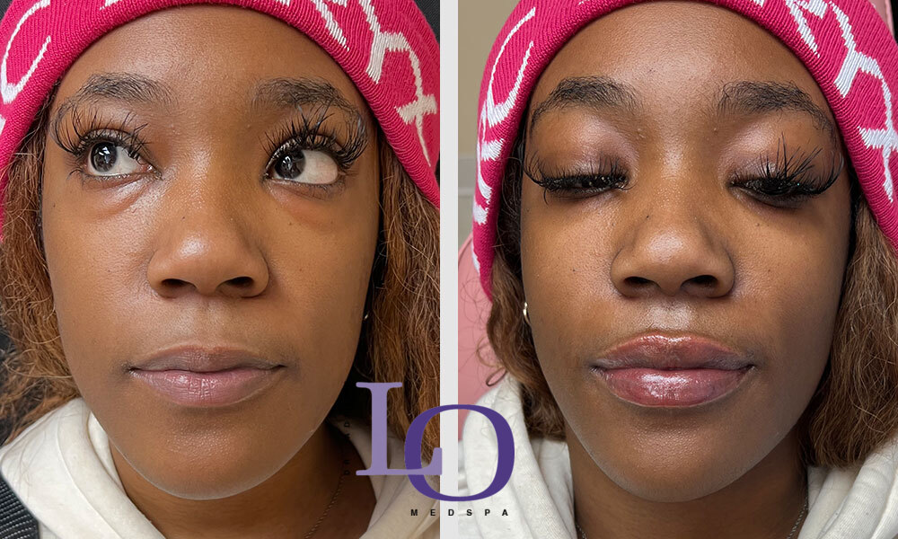 Dermal Fillers - Lips Before and After Patient 1