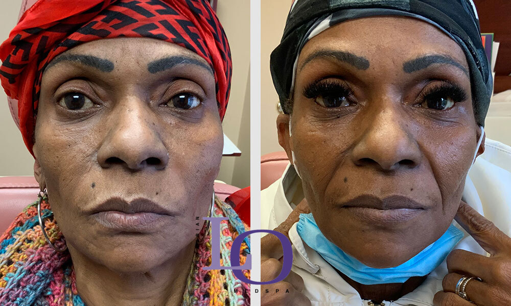 Dermal Fillers - Face Before and After Patient 1