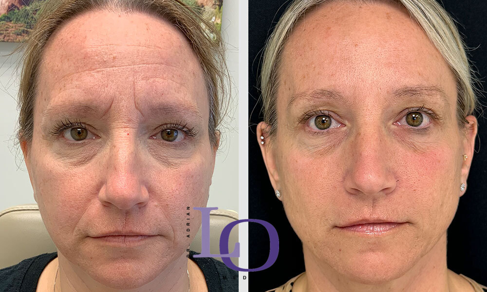Botox® Cosmetic Before and After Patient 1