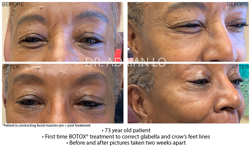 Botox® Cosmetic Before and After Patient 1