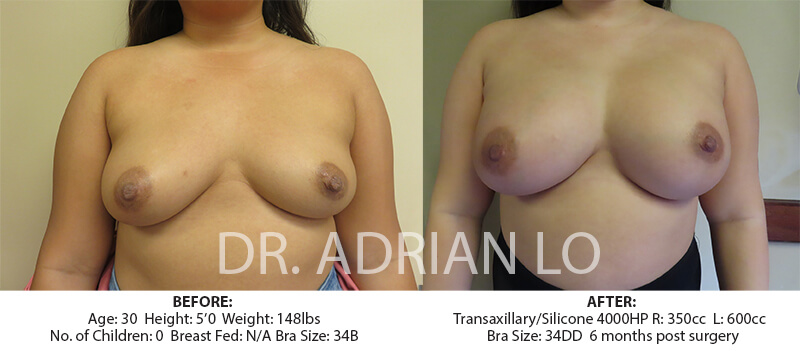 Scarless Breast Augmentation Before and After Patient 1