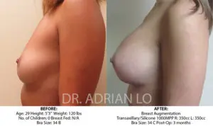 Scarless Breast Augmentation Before and After Patient Thumbnail 5
