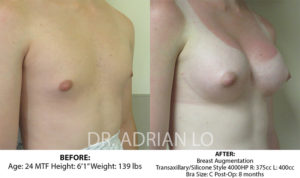 Scarless Breast Augmentation Before and After Patient Thumbnail 2