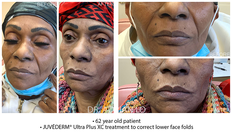 Dermal Fillers - Face Before and After Patient 1