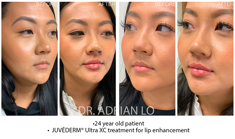 Dermal Fillers - Lips Before and After Patient 1