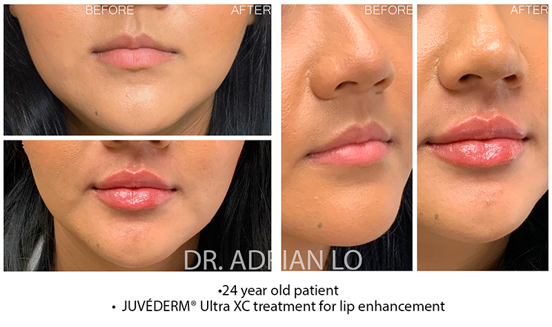 Dermal Fillers - Lips Before and After Patient 1