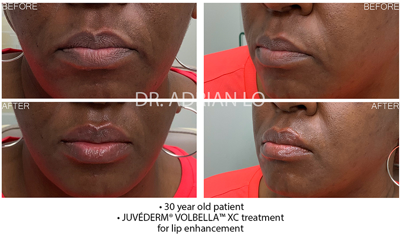 Dermal Fillers - Lips Before and After Patient 1