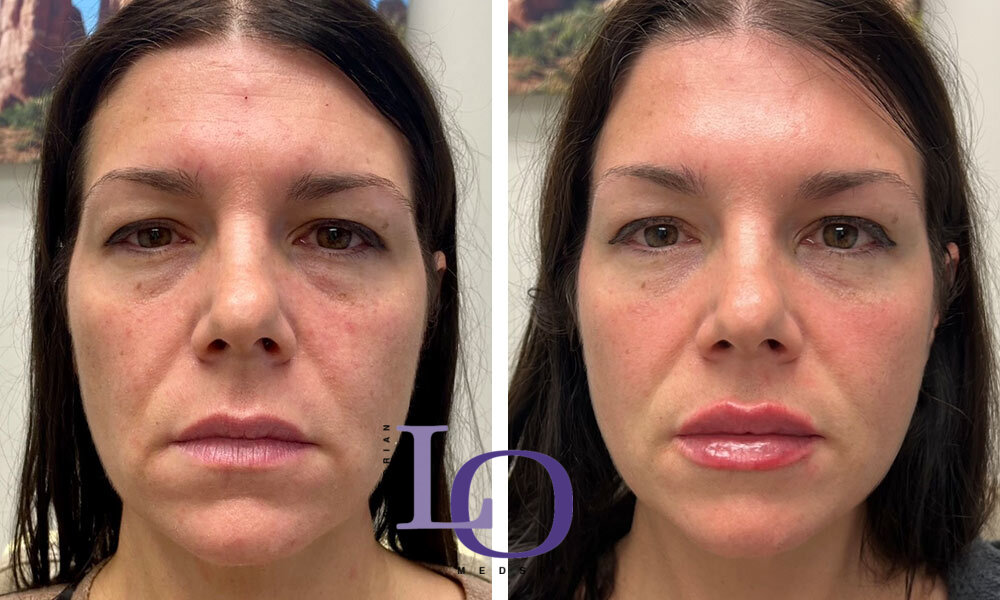 Dermal Fillers - Lips Before and After Patient 1