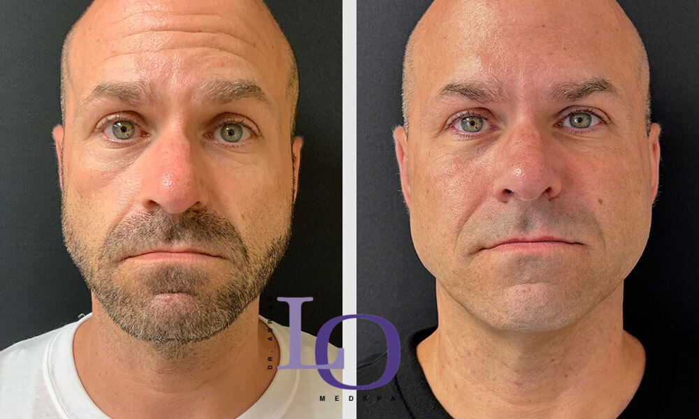 Botox® Cosmetic Before and After Patient 1