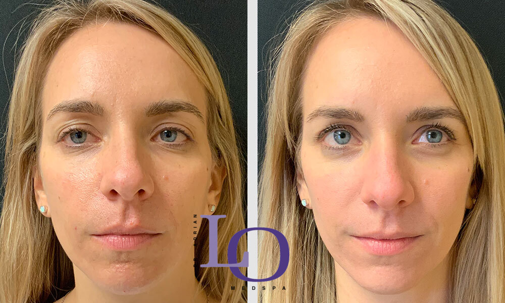 Dermal Fillers - Face Before and After Patient 1