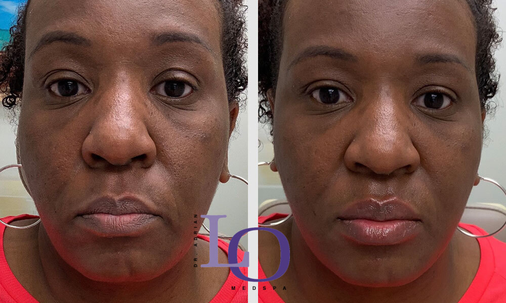 Dermal Fillers - Lips Before and After Patient 1