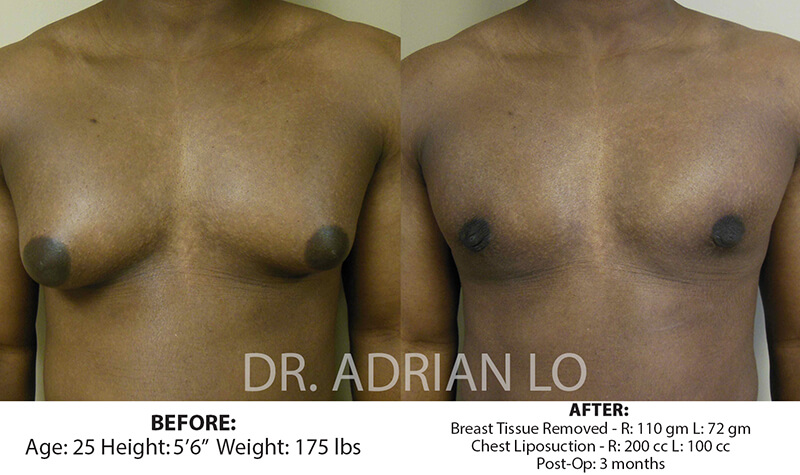 Before and after gynecomastia - patient 2