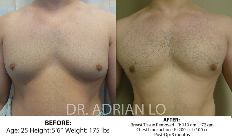 Before and after gynecomastia - patient 3