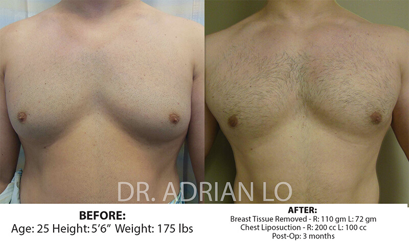 Breast Implant Removal in Philadelphia, PA - Dr. Adrian Lo Plastic Surgery