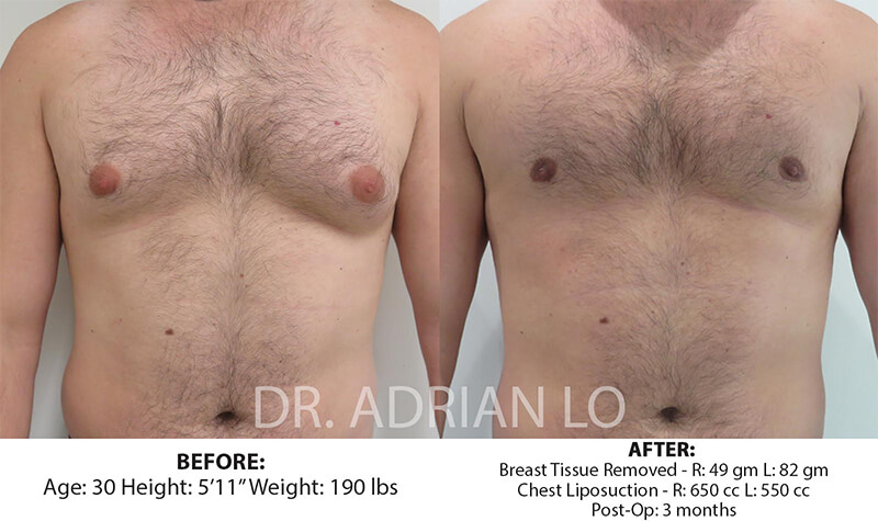 Gynecomastia Correction Before and After Patient 1