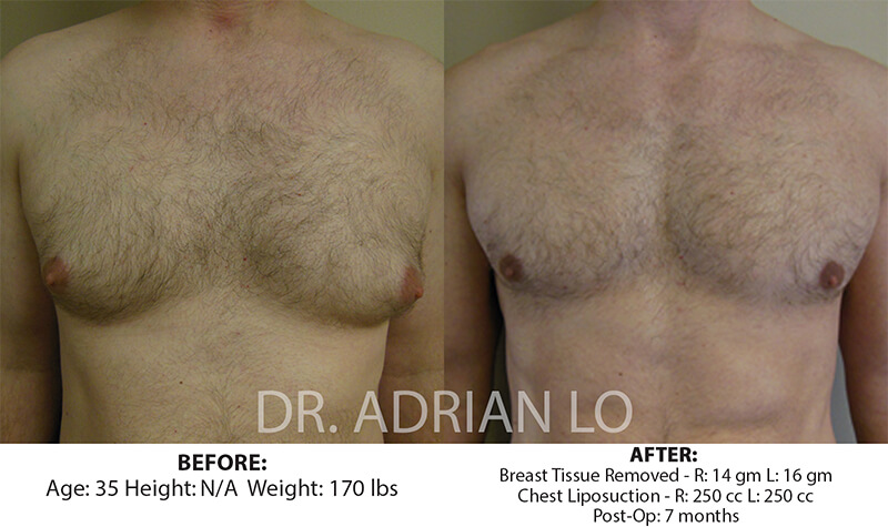 Before and after gynecomastia - patient 1