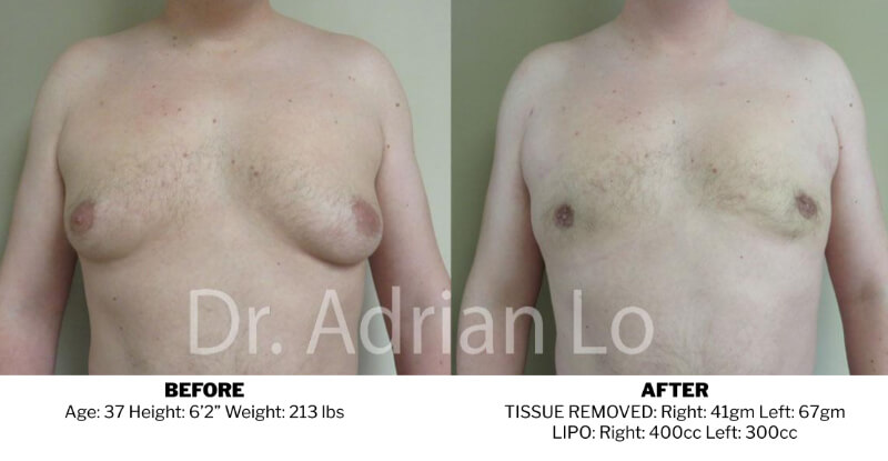 Breast Implant Removal in Philadelphia, PA - Dr. Adrian Lo Plastic Surgery