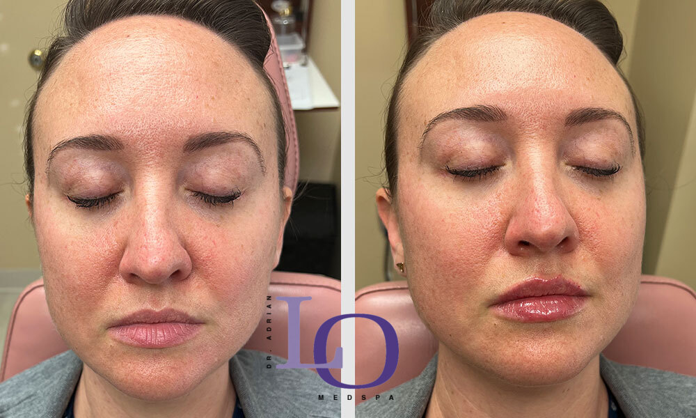 Dermal Fillers - Lips Before and After Patient 1