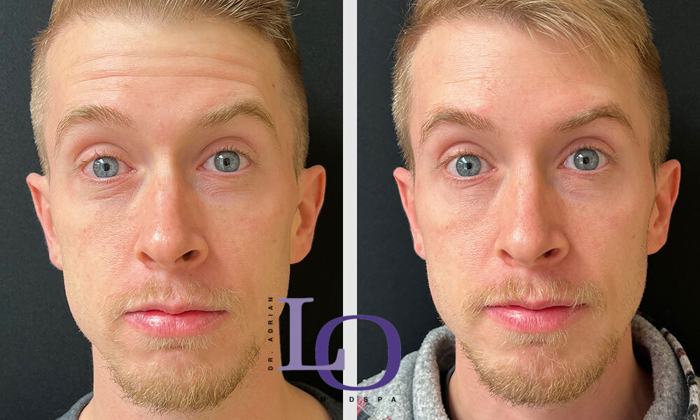 Botox® Cosmetic Before and After Patient 1