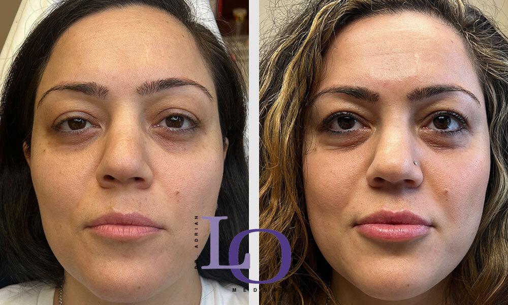 Dermal Fillers - Lips Before and After Patient 1