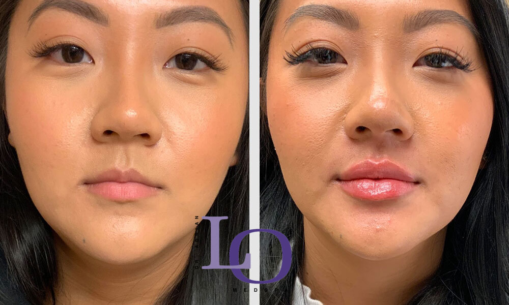 Dermal Fillers - Lips Before and After Patient 1