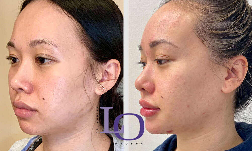 Dermal Fillers - Face Before and After Patient 1
