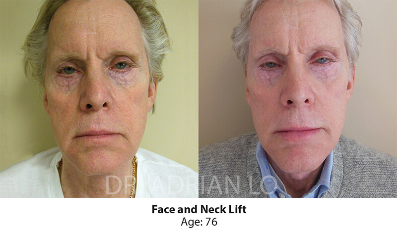 Facial Surgery For Men Before and After Patient 1